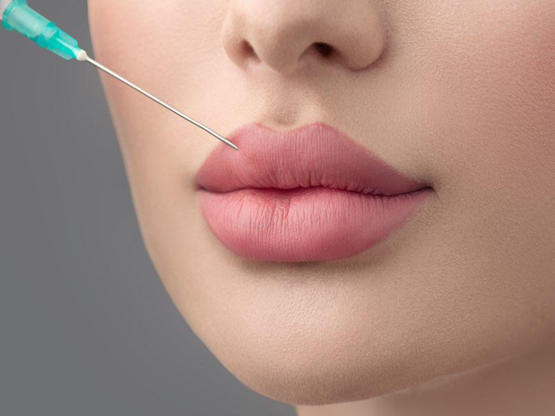 Dolğu (Filler) nədir?